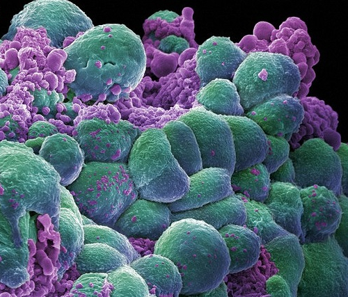 Биоинформатические подходы к изучению и лечению рака легких
