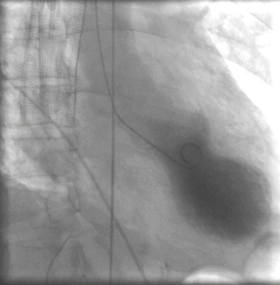 Кардиомиопатия такотсубо