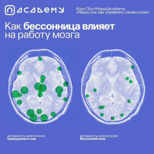 Два состояния одного мозга: как бессонница влияет на человека