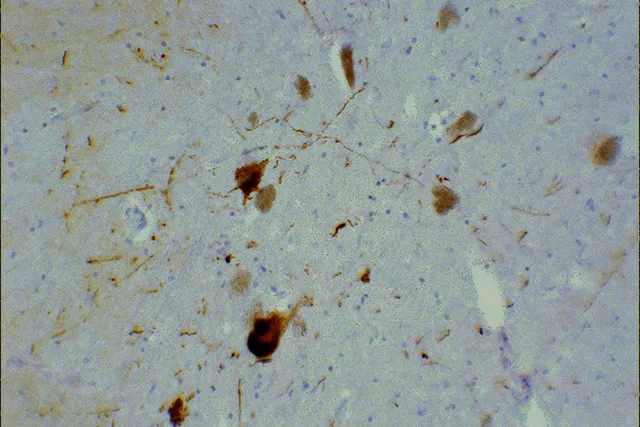 Тельца Леви в черной субстанции среднего мозга