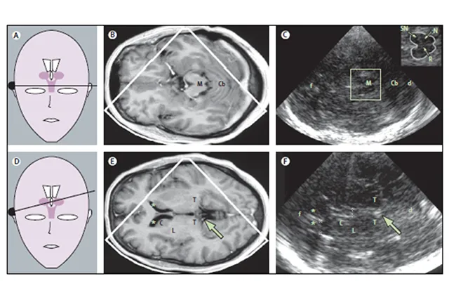 Транскраниальная сонография