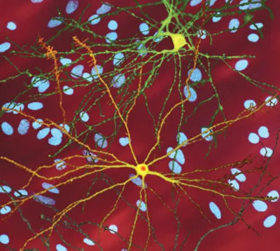 Процесс болезни — нейрон, пораженный тельцами включения