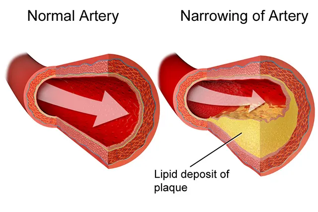 Поражение сосуда