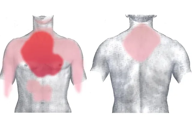 Болевые области при инфаркте миокарда