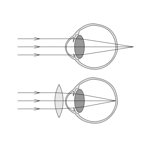 глаз при гиперметропии, двояковыпуклая линза, корректирующая зрение