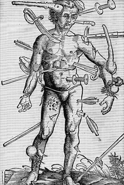 Изображение «израненного человека» из «Руководства» Ганса фон Герсдорфа