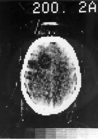 Изображение, полученное на первом компьютерном томографе в 1971 году
