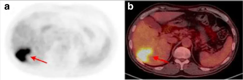 ПЭТ-изображение (слева) и ПЭТ/КТ-изображение (справа), полученные с использованием