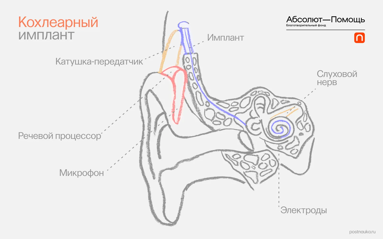 FAQ: Кохлеарная имплантация: как помогают людям с тотальной глухотой